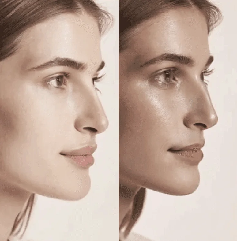 Before and after microneedling: smoother, more even skin