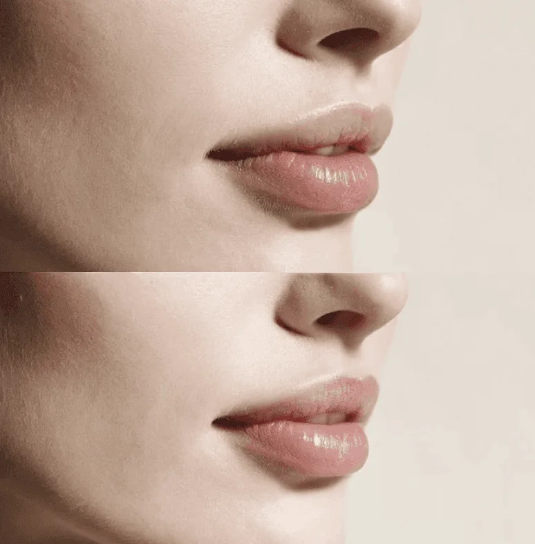 Before and after lip filler: balanced, natural-looking volume
