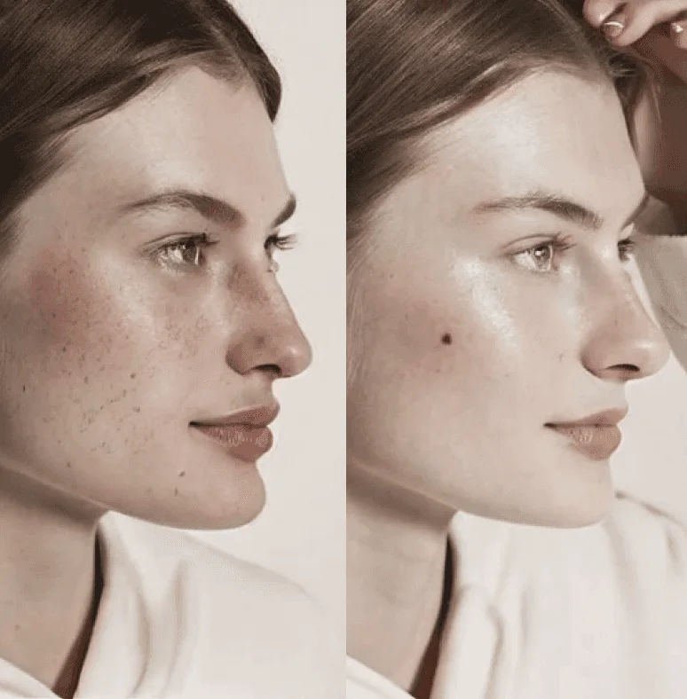 Before and after laser skin treatment: less pigmentation and redness