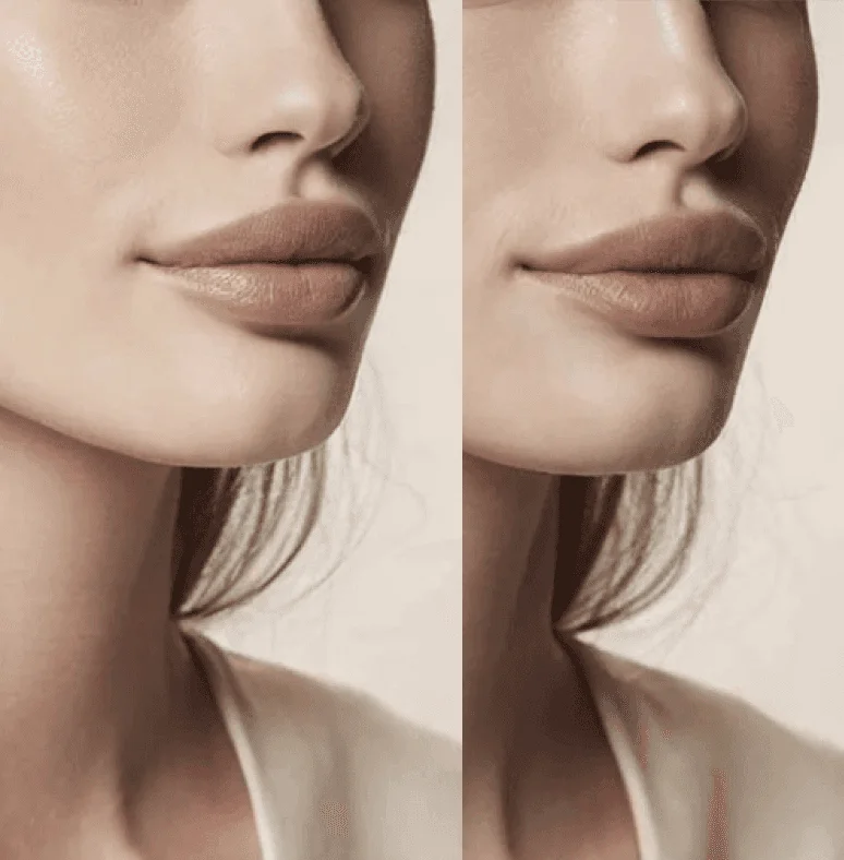 Before and after dermal filler: restored mid-face volume
