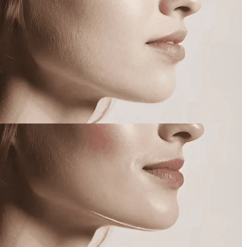 Before and after subtle lip enhancement